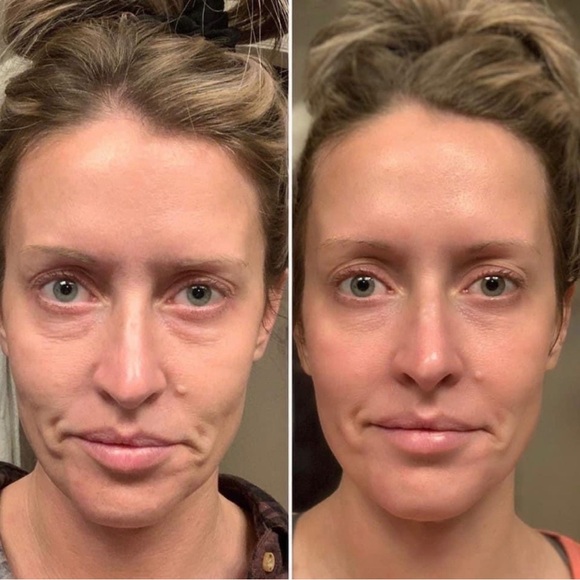 Eye accent bundle for LumiSpa iO - Picture 2 of 2